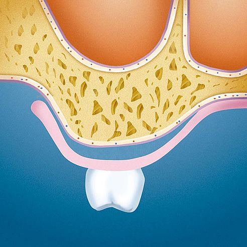 Denture of the interim period (Cavities between jaw ridge and interim denture) | Protefix